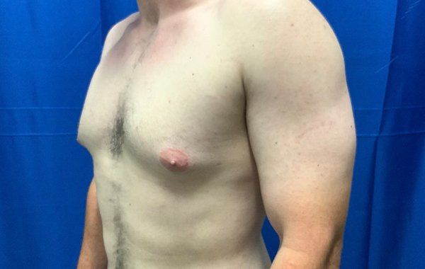 Patient1 Gynecomastia angle before