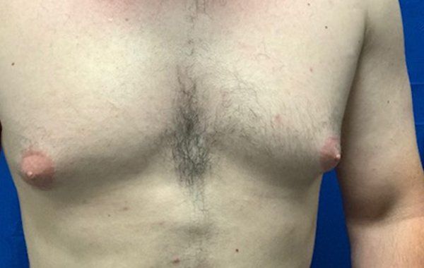 Patient1 Gynecomastia front before