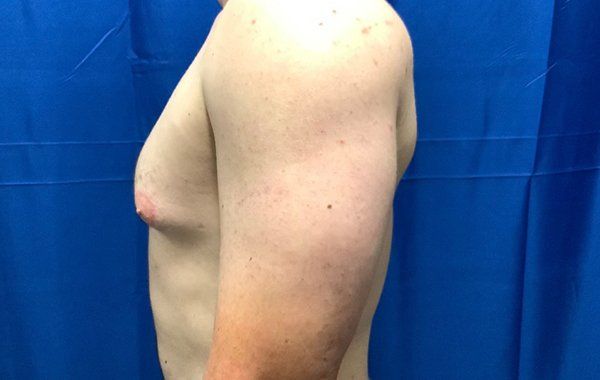 Patient1 Gynecomastia side before