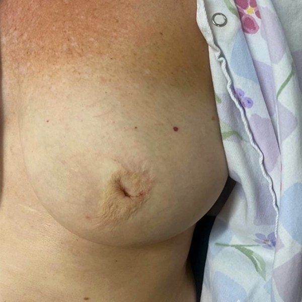 Inverted nipples are a condition in which the entire nipple points inward instead of outward. It is common for women to have this condition with either one or both of their nipples. Adhesions beneath the nipples from milk ducts that bind the skin to the underlying tissues often cause nipples to invert. Luckily we have ways to correct the inverted nipple and restore normal anatomy! Pictured is a 67 year old patient few months after in office correction of inverted nipple deformity