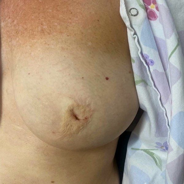 Inverted nipples are a condition in which the entire nipple points inward instead of outward. It is common for women to have this condition with either one or both of their nipples. Adhesions beneath the nipples from milk ducts that bind the skin to the underlying tissues often cause nipples to invert. Luckily we have ways to correct the inverted nipple and restore normal anatomy! Pictured is a 67 year old patient few months after in office correction of inverted nipple deformity Inverted nipples are a condition in which the entire nipple points inward instead of outward. It is common for women to have this condition with either one or both of their nipples. Adhesions beneath the nipples from milk ducts that bind the skin to the underlying tissues often cause nipples to invert. Luckily we have ways to correct the inverted nipple and restore normal anatomy! Pictured is a 67 year old patient few months after in office correction of inverted nipple deformity