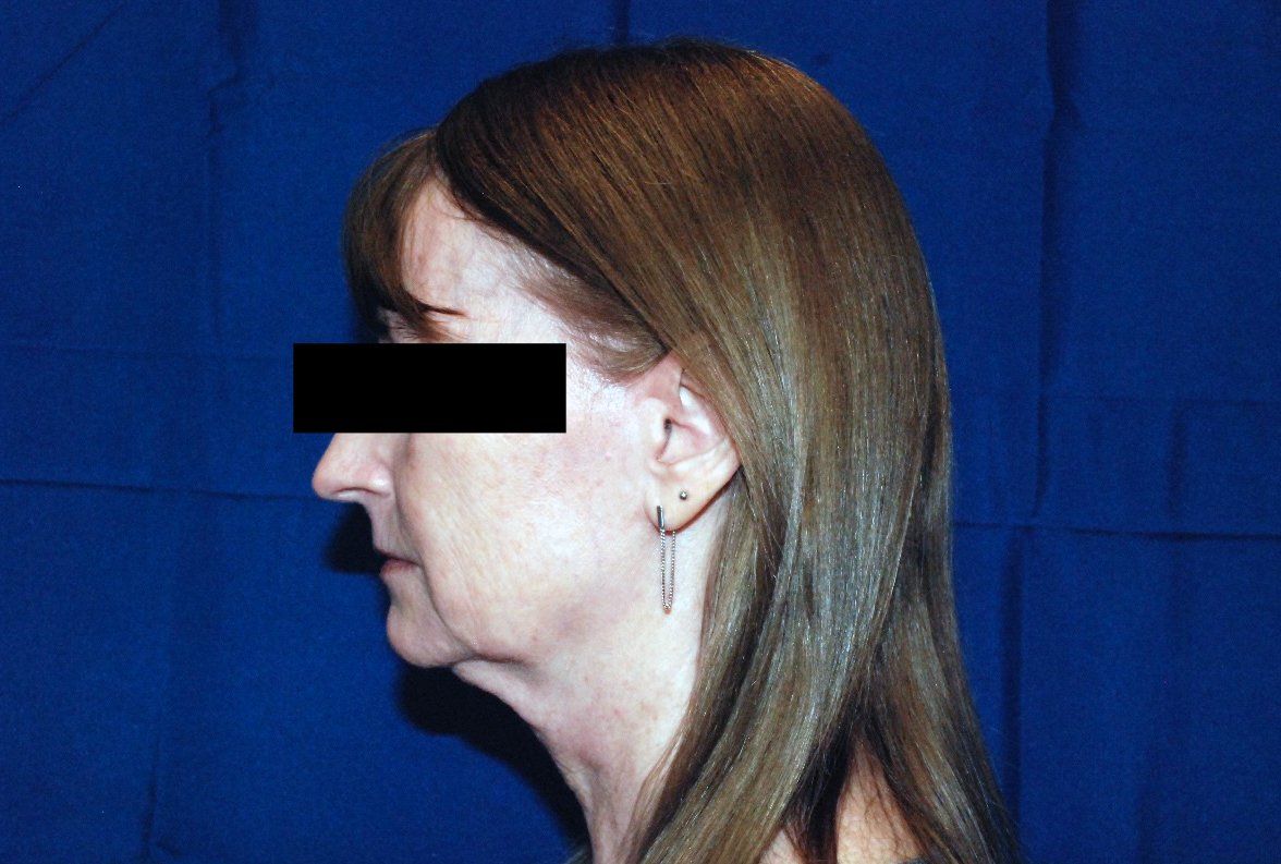 Patient1 facelift side before