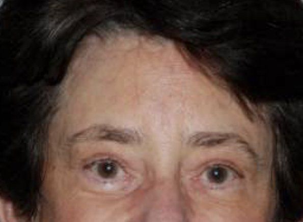 browlift after browlift after