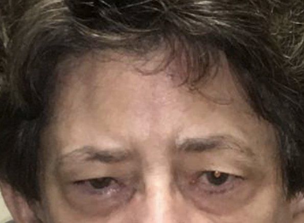 browlift before browlift before