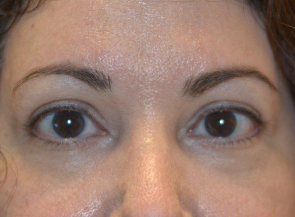 Patient3 brow lift front after Patient3 brow lift front after