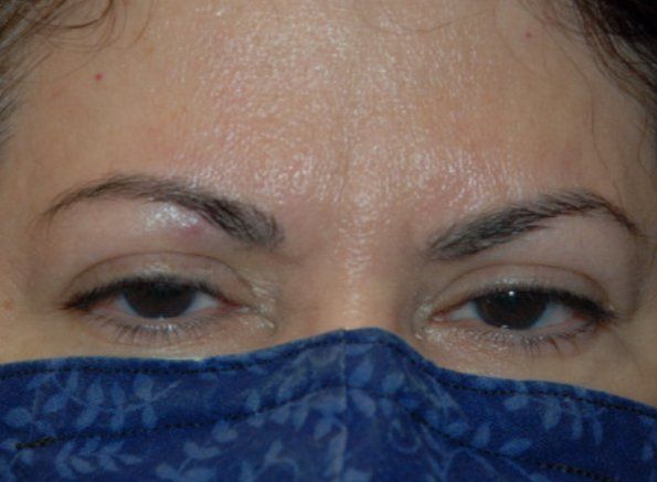 Patient3 brow lift front before Patient3 brow lift front before