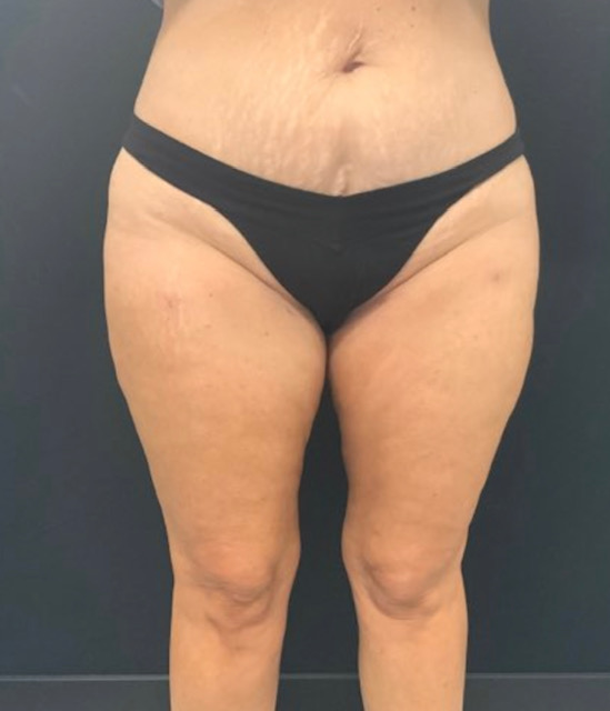 56 year old female shown 3 months after inner and outer thigh liposuction.