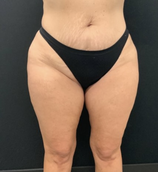 56 year old female shown 3 months after inner and outer thigh liposuction.