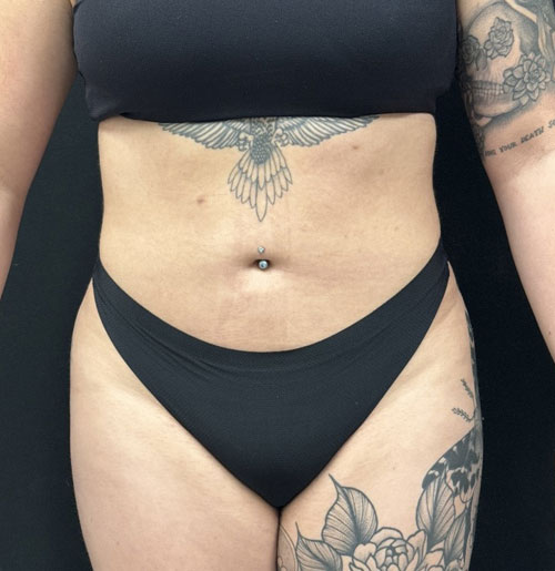 28 year old 3 months after 360 degree liposuction