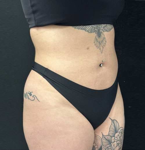 28 year old 3 months after 360 degree liposuction