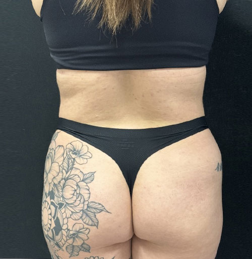 28 year old 3 months after 360 degree liposuction