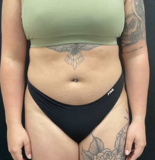 28 year old 3 months after 360 degree liposuction