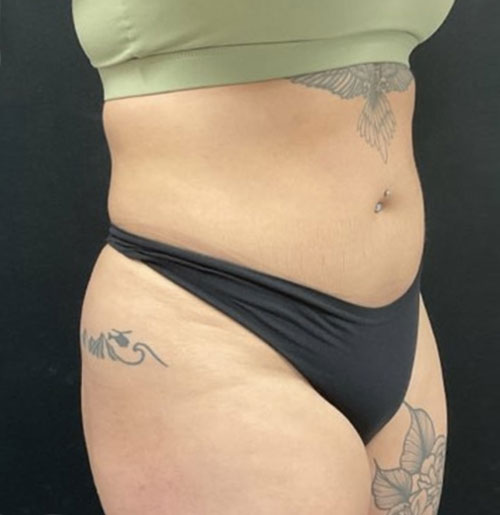 28 year old 3 months after 360 degree liposuction