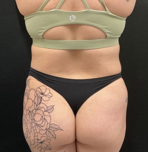 28 year old 3 months after 360 degree liposuction
