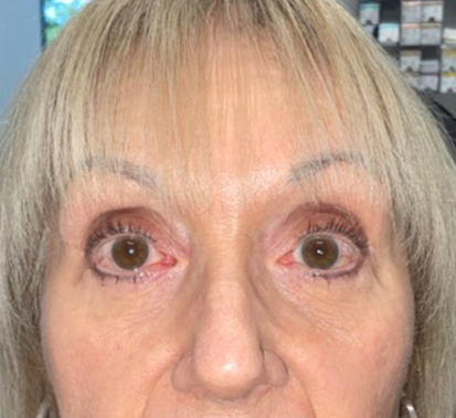 Bags under the eyes can convey a haggard facial appearance. This pleasant patient is shown before and 3 months after the surgery to remove the lower lid bags performed in the office under local anesthesia by Dr.Leyngold. We are so happy with her more rested and rejuvenated appearance.