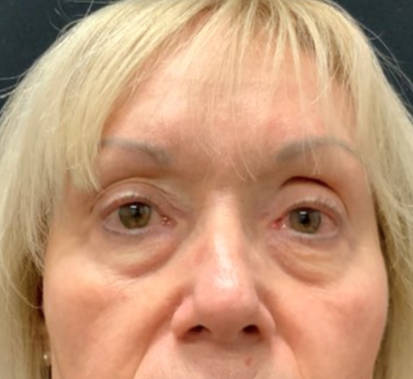 Bags under the eyes can convey a haggard facial appearance. This pleasant patient is shown before and 3 months after the surgery to remove the lower lid bags performed in the office under local anesthesia by Dr.Leyngold. We are so happy with her more rested and rejuvenated appearance.