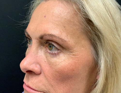 Lower Blepharoplasty patient7 left side view after image