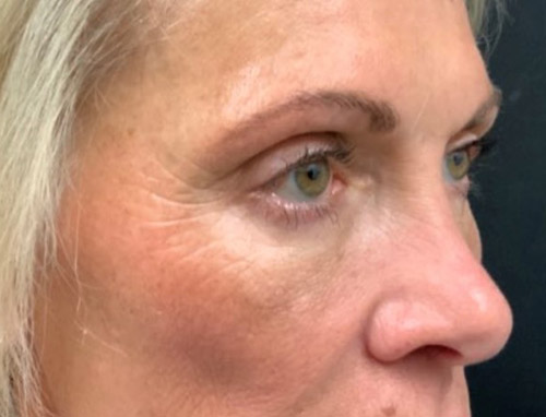 Lower Blepharoplasty patient7 right side view after image