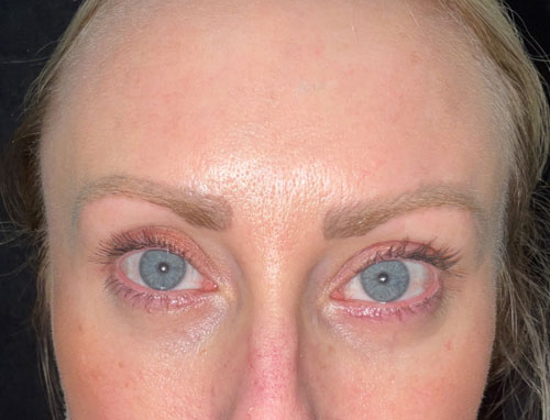 This wonderful young lady is shown before and 2 months after lower blepharoplasty and 30% TCA chemical peel of her face. She is very happy with her eye appearance and looks more rested and refreshed.