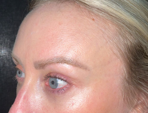 This wonderful young lady is shown before and 2 months after lower blepharoplasty and 30% TCA chemical peel of her face. She is very happy with her eye appearance and looks more rested and refreshed.