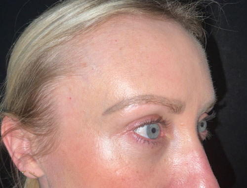 This wonderful young lady is shown before and 2 months after lower blepharoplasty and 30% TCA chemical peel of her face. She is very happy with her eye appearance and looks more rested and refreshed.