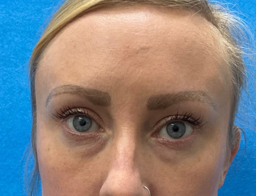 This wonderful young lady is shown before and 2 months after lower blepharoplasty and 30% TCA chemical peel of her face. She is very happy with her eye appearance and looks more rested and refreshed.