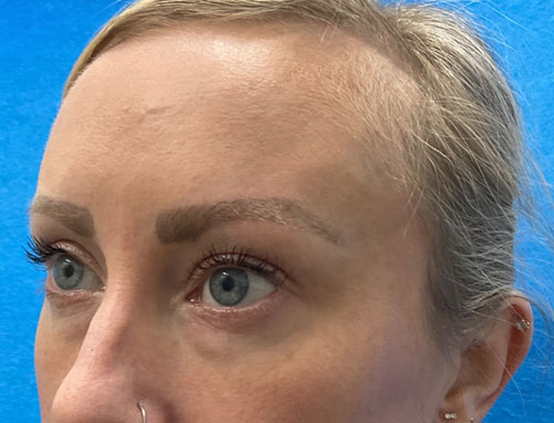 This wonderful young lady is shown before and 2 months after lower blepharoplasty and 30% TCA chemical peel of her face. She is very happy with her eye appearance and looks more rested and refreshed.