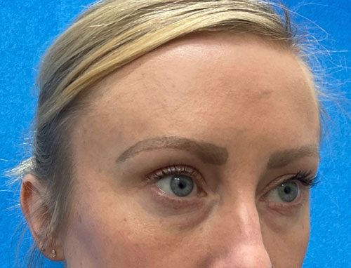 This wonderful young lady is shown before and 2 months after lower blepharoplasty and 30% TCA chemical peel of her face. She is very happy with her eye appearance and looks more rested and refreshed.