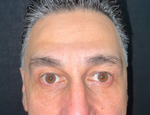 This very pleasant gentleman is shown before and 3 months after lower blepharoplasty (lower lid bag removal) performed in the office. He is thrilled with his improvements as are we.