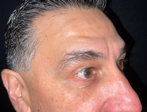 This very pleasant gentleman is shown before and 3 months after lower blepharoplasty (lower lid bag removal) performed in the office. He is thrilled with his improvements as are we.