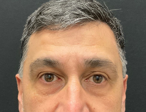 This very pleasant gentleman is shown before and 3 months after lower blepharoplasty (lower lid bag removal) performed in the office. He is thrilled with his improvements as are we.