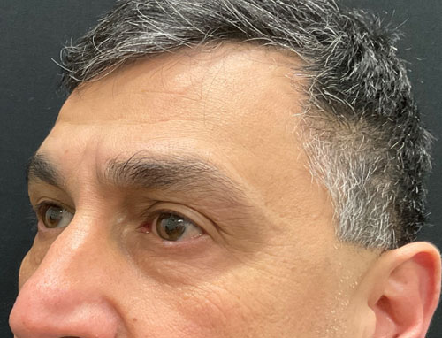 This very pleasant gentleman is shown before and 3 months after lower blepharoplasty (lower lid bag removal) performed in the office. He is thrilled with his improvements as are we.