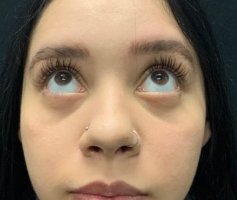 20 year old female shown 3 months after bilateral transconjuctival lower blepharoplasties