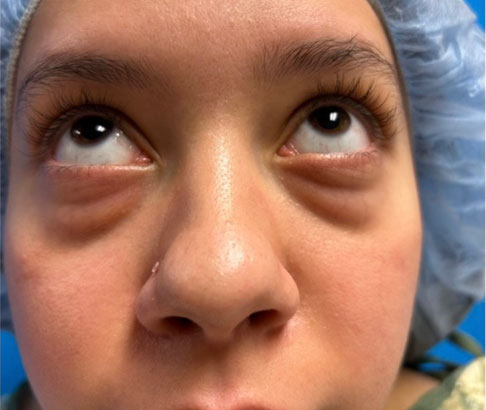20 year old female shown 3 months after bilateral transconjuctival lower blepharoplasties