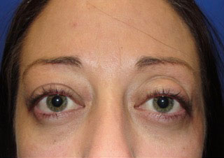 Patient2 lower-blepharoplasty front view after
