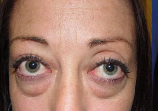 Patient2 lower-blepharoplasty front view before