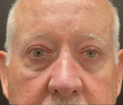 Male Blepharoplasty before and after patient front view
