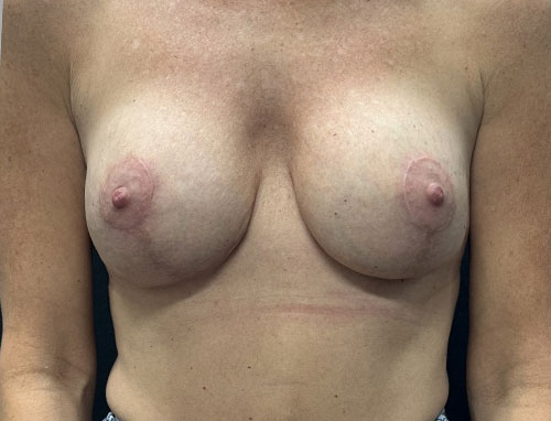 49 year old female 8 months after bilateral breast augmentation with 215 cc moderate plus profile implants and vertical mastopexy.