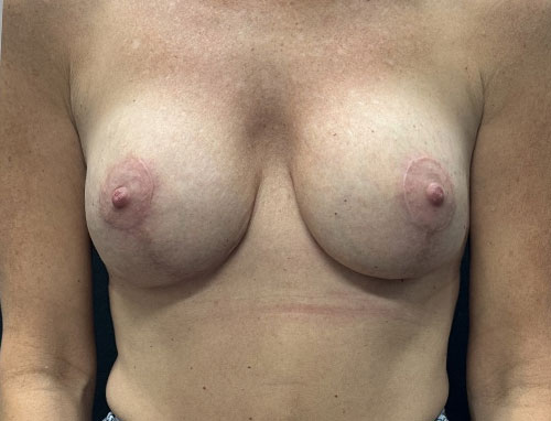 49 year old female 8 months after bilateral breast augmentation with 215 cc moderate plus profile implants and vertical mastopexy. 49 year old female 8 months after bilateral breast augmentation with 215 cc moderate plus profile implants and vertical mastopexy.