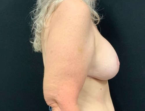 60 year old female shown 3 months after revision of prior breast augmentation with capsulectomy, implant exchange to 305 moderate profile plus gel implants and mastopexy