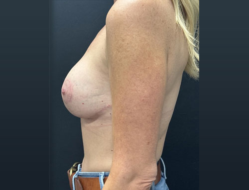 49 year old female 8 months after bilateral breast augmentation with 215 cc moderate plus profile implants and vertical mastopexy.