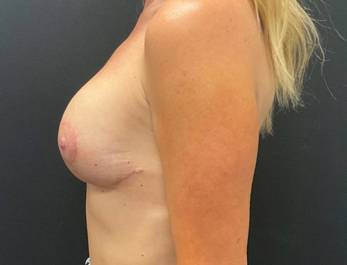 49 year old female 6 weeks after bilateral breast augmentation with 215 cc moderate plus profile implants and vertical mastopexy.
