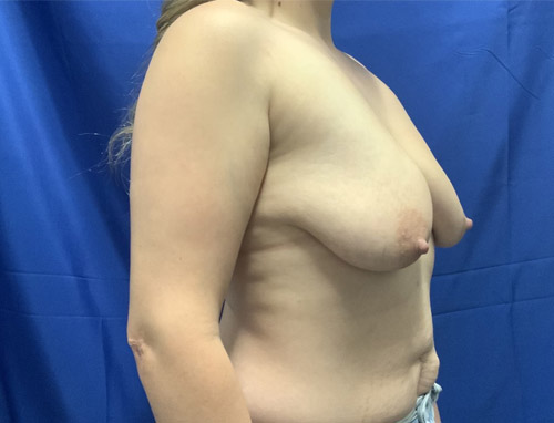 29 year-old -female 3 months after mastopexy and breast augmentation with 325 cc MP Sientra silicone gel round implants and axillary liposuction.