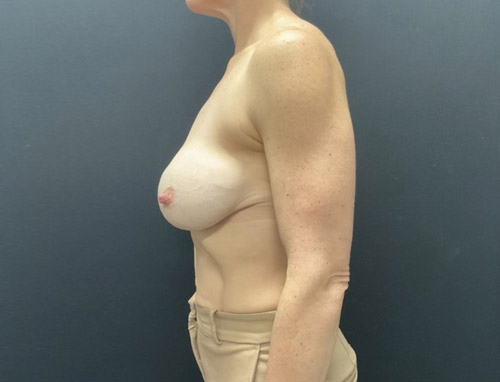 Patient in her 40s 3.5 months after implant exchange to silicone gel highly cohesive implants, mastopexy and durasorb (aka internal bra support)