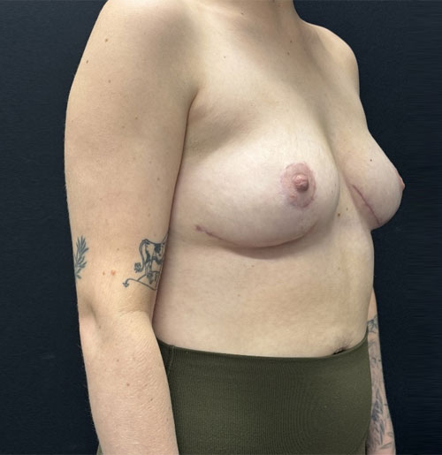 Shown is a 27-year-old female only 3 months after mastopexy with auto augmentation with her own natural tissue. Her scars to are still healing and will continue to improve over the next year