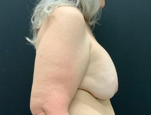 60 year old female shown 3 months after revision of prior breast augmentation with capsulectomy, implant exchange to 305 moderate profile plus gel implants and mastopexy