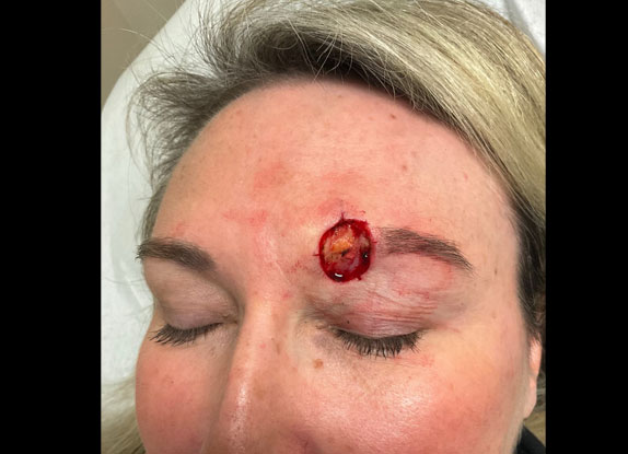 Before and 9 months after MOHS resection of a basal cell carcinoma