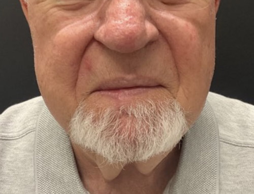 A man in his 70s 3 months after lower lip reconstruction after MOHS resection of a squamous cell carcinoma. He regained full speech and lip competence
