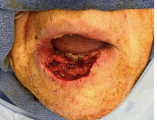 A man in his 70s 3 months after lower lip reconstruction after MOHS resection of a squamous cell carcinoma. He regained full speech and lip competence