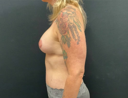 41 year old 3 months sp full abdominoplasty with liposuction of the upper abdomen and flanks and in addition she has smooth Sientra Moderate profile implants with a breast lift. She has been consistent with her postoperative diet and followed instructions and her results speak for themselves.